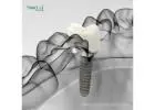 Dental Implant Manufacturers in Peru | Quality & Affordable
