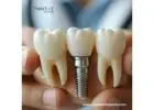 Best Leading Dental Implant Manufacturers in Paraguay