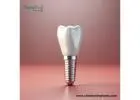 Dental Implant Products Wholesale In mexico For Growth