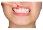 Best Braces Treatment In Gurgaon