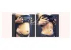 Latest Tummy Tuck Surgery Techniques Available Today