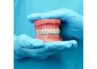 Straighten Your Teeth with Braces Treatment in