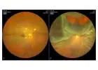 Finding the Best Retina Surgeon for Advanced Eye Care
