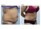 Latest Liposuction Technologies Used by Leading Surgeons
