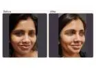 Dimple Creation Surgery Cost in Delhi - Dr Rajat Gupta