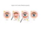 Eyelid surgery cost in Delhi - Dr Rajat Gupta