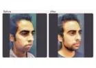 Chin Augmentation in Delhi - Dr Rajat Gupta