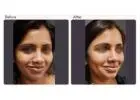 Dimple Creation Surgery in Delhi - Dr Rajat Gupta