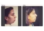 Chin Augmentation in Delhi - Dr Rajat Gupta