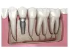 Dental Implants in Abbotsford, BC | Complete Patient Guide