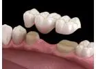 Dental Bridges in Abbotsford | Restore Missing Teeth Naturally