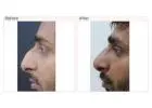 Rhinoplasty Surgery in Delhi - Dr Rajat Gupta