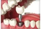 Infected Tooth Extraction in Abbotsford | Safe Dental Care