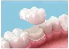 What Is a Dental Crown? Cost, Types & Benefits in Abbotsford