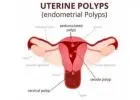 Hysteroscopy Procedure in Delhi - Dr Rhythm Gupta